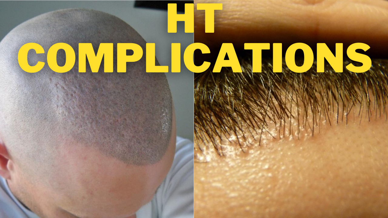 Hair Transplant Complications What Are They And How To Avoid Them